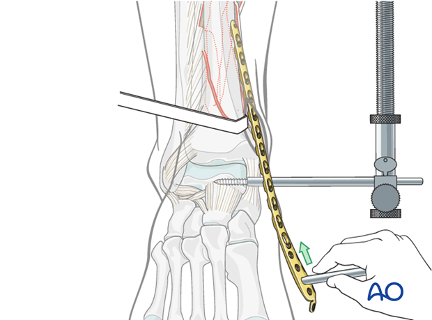 MIO plate insertion to treat distal tibia fracture
