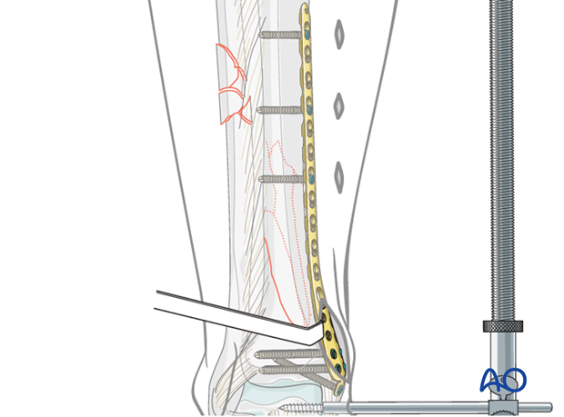 Screw insertion for plate fixation to treat distal tibia fracture