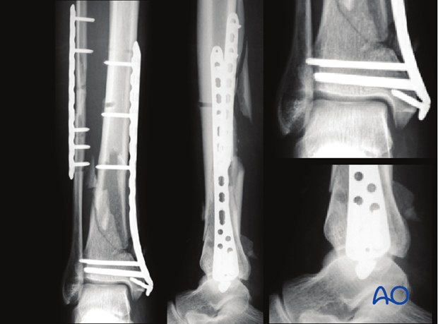 Radiographic assessment of MIO for distal tibia fracture and fibula
