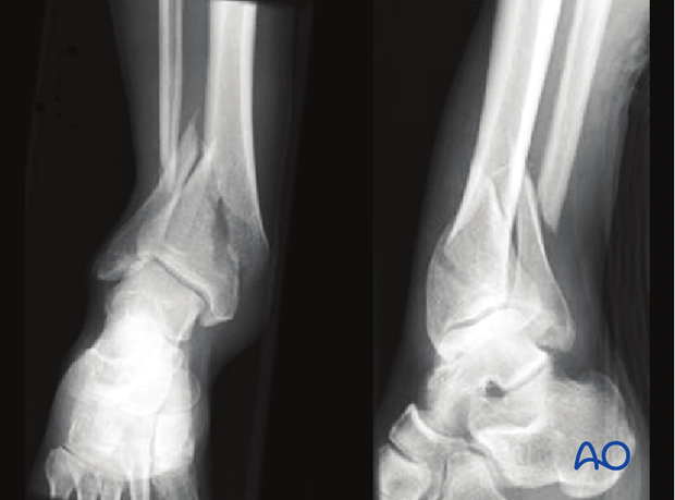 distal tibia fracture