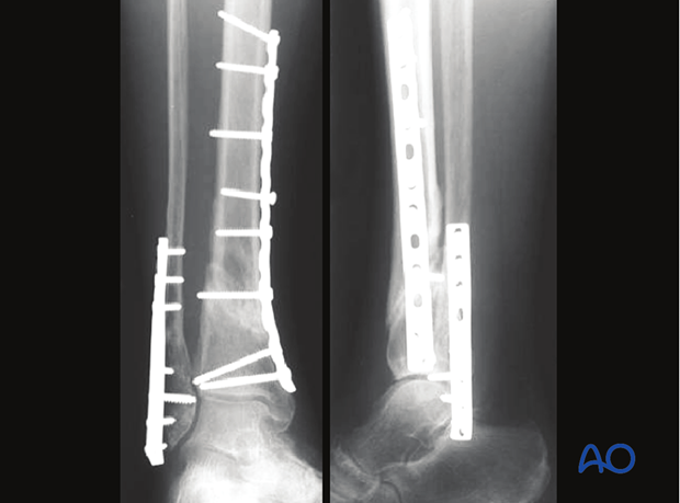 Example of treatment of extraarticular fracture of distal tibia and fibula