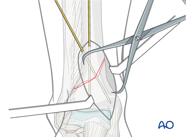 Direct reduction of distal tibia fracture