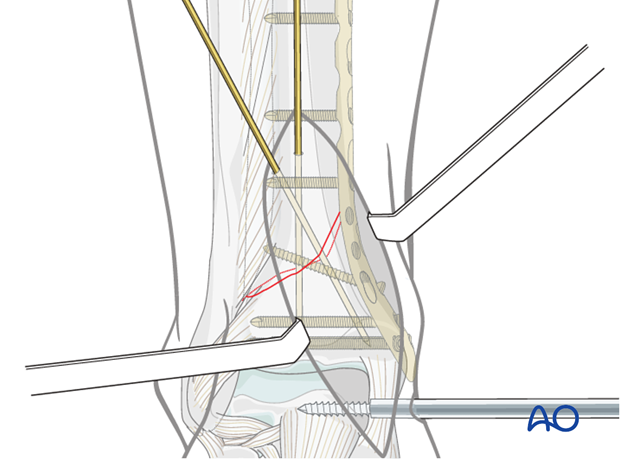 K-wire positioning in compression plating fixation of distal tibia fracture