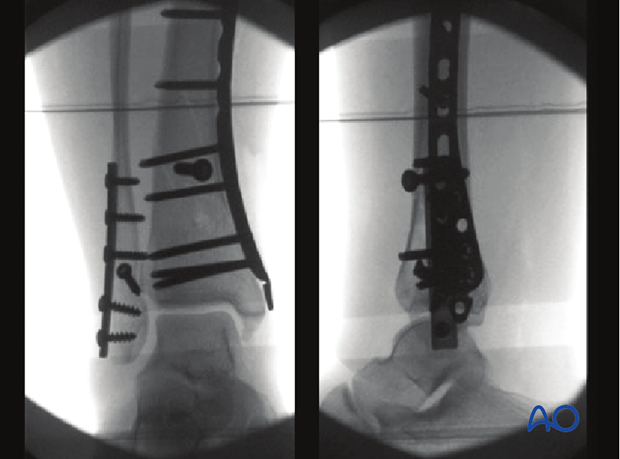 Fluoroscopic imaging of a distal tibia and fibula fracture treated with compression plate