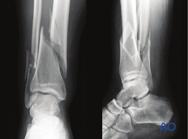 Radiographic example of extraarticular distal tibia fracture