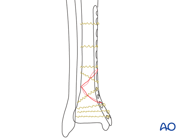 Preoperative planning for treatment of distal tibia fracture