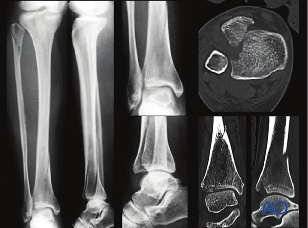 Radiographic example of pure split fracture of the distal tibia