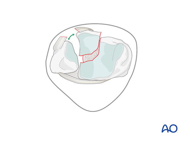 ORIF - Buttress plate and lag screws for Partial articular, split fracture