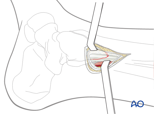 Posteromedial approach to the distal tibia