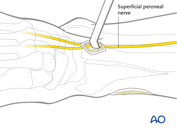 Distal anterolateral approach to the distal tibia