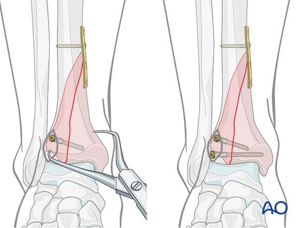 Lag screw positioning to treat a pure split fracture of the distal tibia