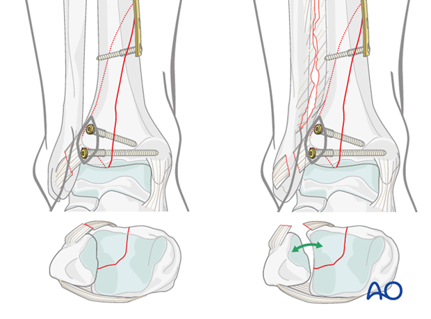 Suprasyndesmotic fibulotibial screw to stabilize the ankle mortise