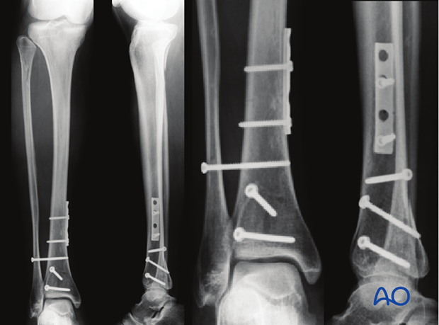 Radiographic example of buttress plating and lag screws to fix a pure split fracture of the distal tibia