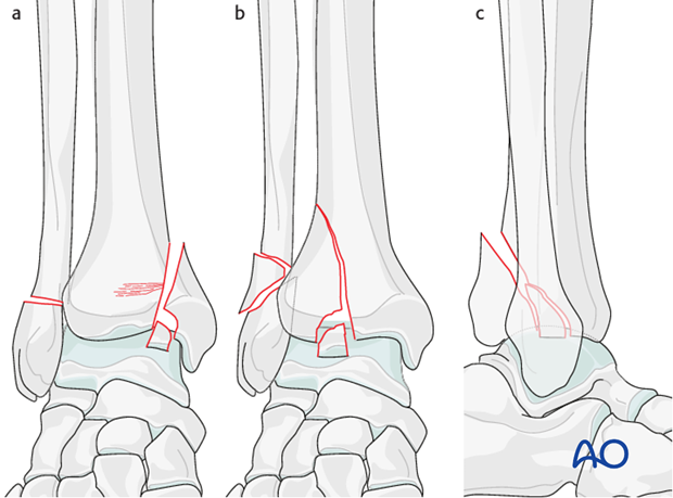 Partial articular distal tibia fracture