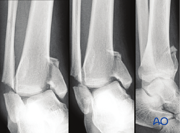 Preoperative x-rays showing a transverse fracture of the lateral malleolus combined with a vertical fracture of the medial distal tibia