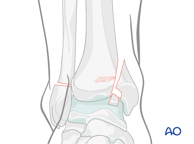 Split depression fracture of the distal tibia
