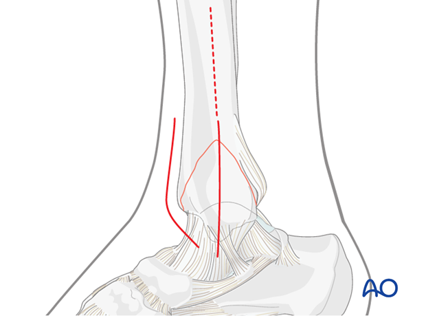 Approach to the distal tibia to access to a split depression fracture