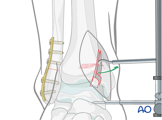 Joint exposure to treat a split depression fracture of the distal tibia