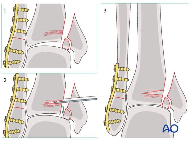 Reduction of impacted segment of a split depression fracture of the distal tibia