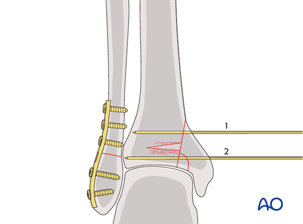 Temporary stabilization of impacted segment of a split depression fracture of the distal tibia