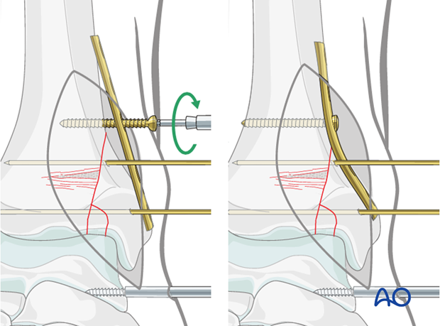 Medial buttress plate positioning to fix a split depression fracture of the distal tibia