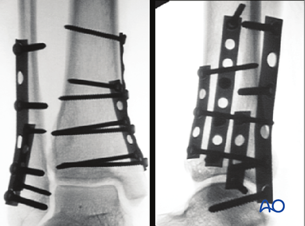 Intraoperative x-rays showing fixation of a transverse fracture of the lateral malleolus and a vertical fracture of the medial distal tibia