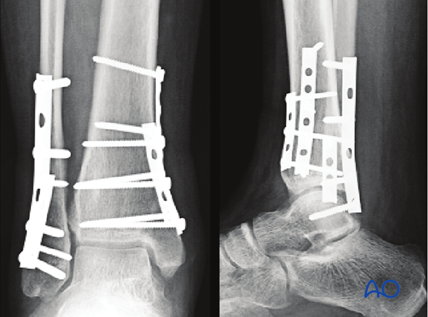 Postoperative x-rays showing fixation and healing of a transverse fracture of the lateral malleolus and a vertical fracture of the medial distal tibia