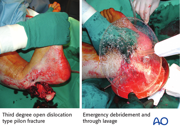 Example of extraarticular open fracture