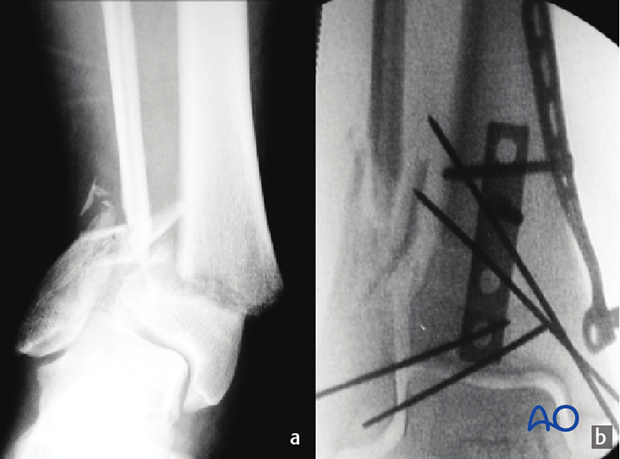 Radiographic example of multifragmentary fibular fracture