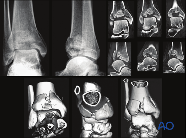 Preoperative imaging of a partial articular, depression fracture of the distal tibia