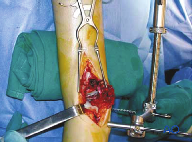Application of a large distractor in a distal tibia fracture