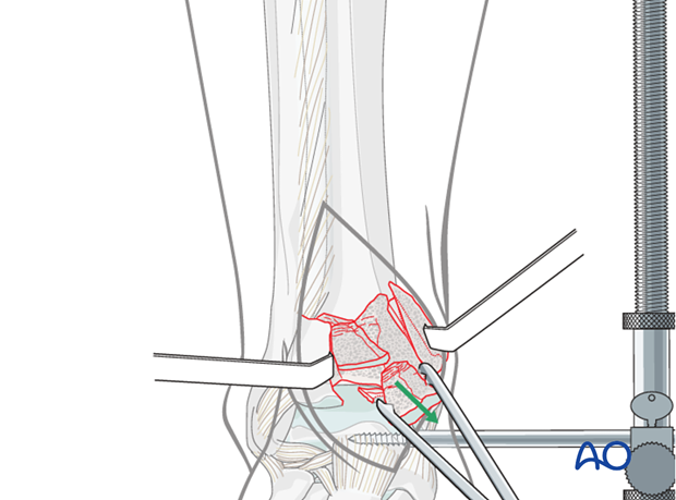 Removal of central fragment of a depression fracture of the distal tibia