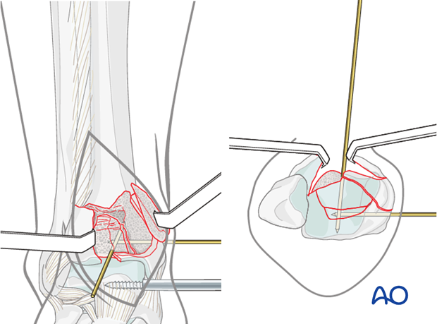 Reduction of central fragment of a depression fracture of the distal tibia