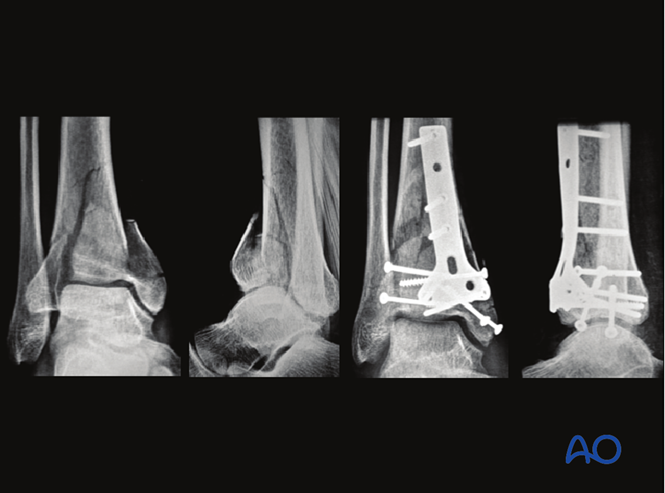Oref Leg ORIF - Buttress plate and lag screws for Partial articular, depression ...