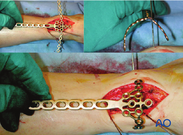 Plate contouring to treat distal tibia fracture