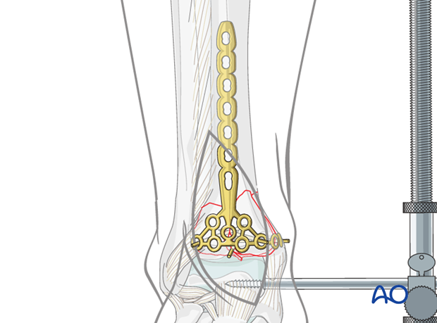 Plate insertion to treat distal tibia fracture
