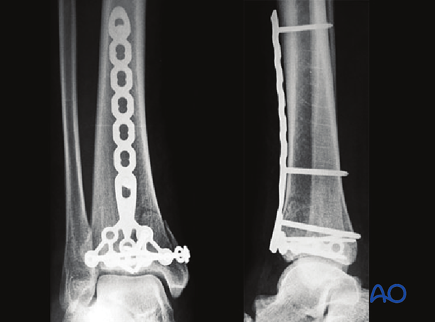 Partial articular, depression fracture of the distal tibia treated with buttress plate and lag screws