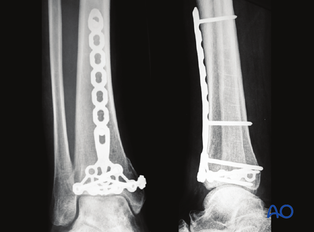 Radiographic example of plating of a distal tibia fracture at 3 months postoperative