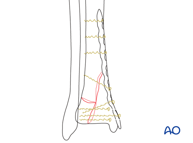 Preoperative planning to treat a complete articular, simple fracture of the distal tibia