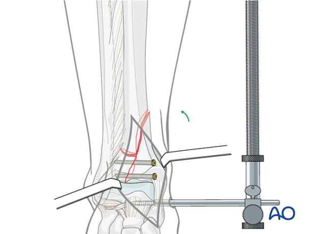 Adjusting distractor tension in a complete articular, simple fracture of the distal tibia