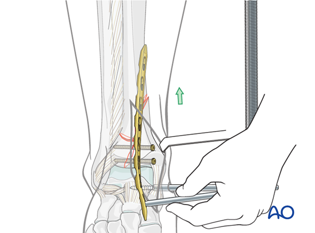 Plate insertion to treat distal tibia fracture