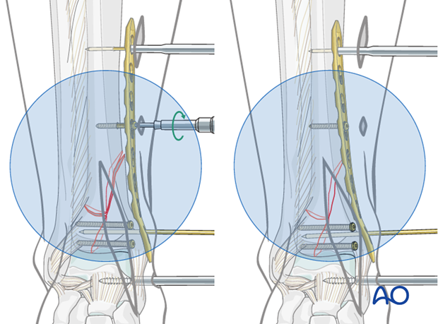 Reduction of the metaphyseal fragment of the distal tibia