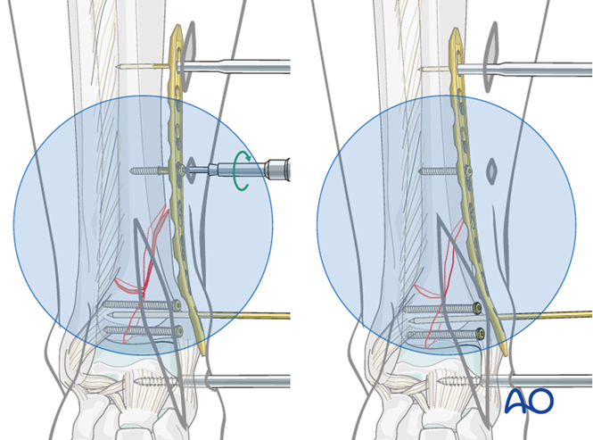 Oref Leg ORIF - Plate and screws for Complete simple articular, simple ...