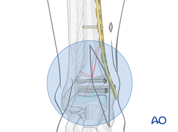 Fixation of the distal fragment of the distal tibia