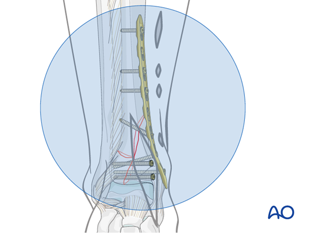 Definitive plate fixation to treat a distal tibia fracture