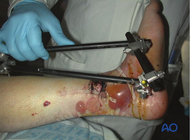 Example of associated transverse traumatic wound at the distal tibia