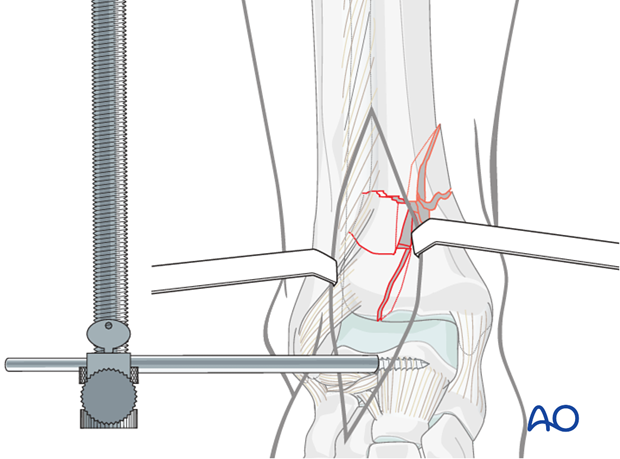 Distractor application in a distal tibia fracture