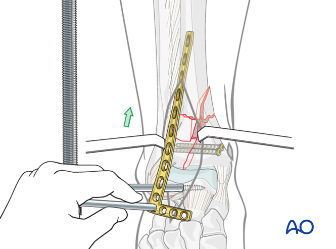 Oref Leg ORIF - Plate and screws for Complete simple articular, multifragmentary ...
