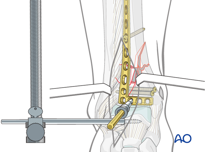 Oref Leg ORIF - Plate and screws for Complete simple articular, multifragmentary ...