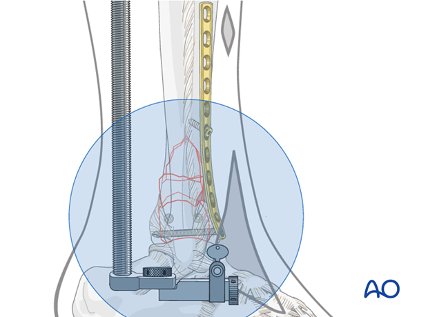Distal screw positioning for plate fixation to treat distal tibia fractures